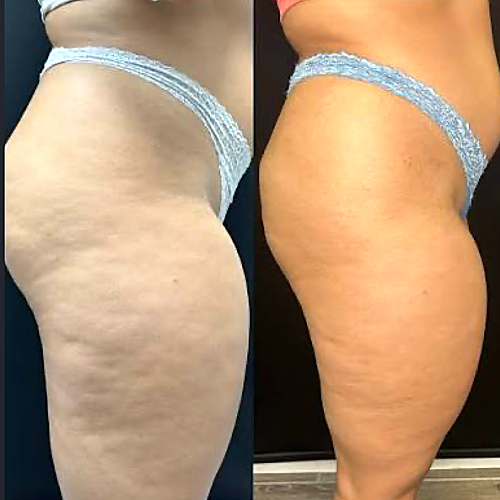 Cryo Thermo Cellulite Gel